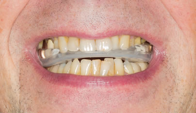 Dolor de Muelas por bruxismo | Clínica Dental Artdenta Valencia