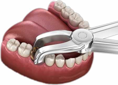 Extracción Piezas | Clínica Dental Artdenta Valenciato gingival_clinica_artdenta_valencia