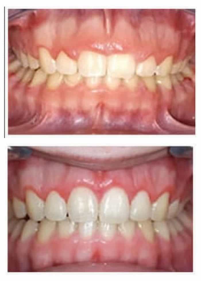 Gingivectomia, ¿Qué es? Técnicas, diagnóstico Clínica Dental en