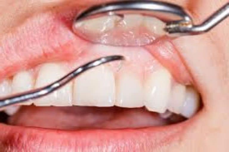 Gingivectomia, ¿Qué es? Técnicas, diagnóstico Clínica Dental en