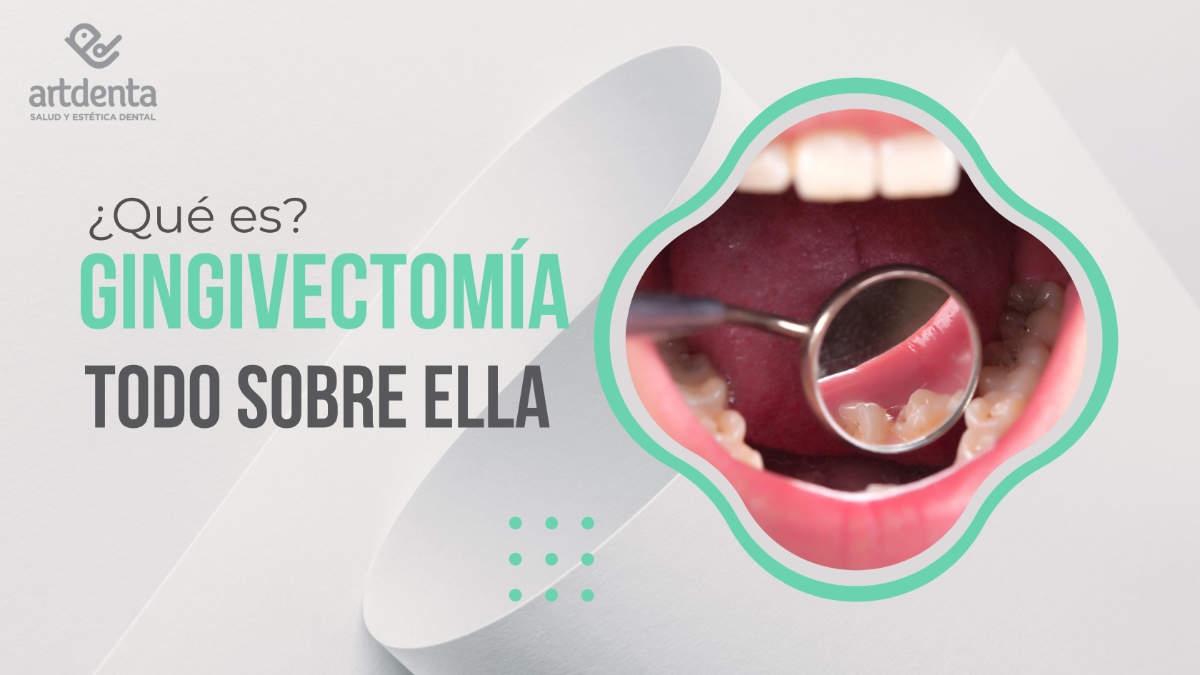 Banner Gingivectomía | Clínica Dental Artdenta Valencia