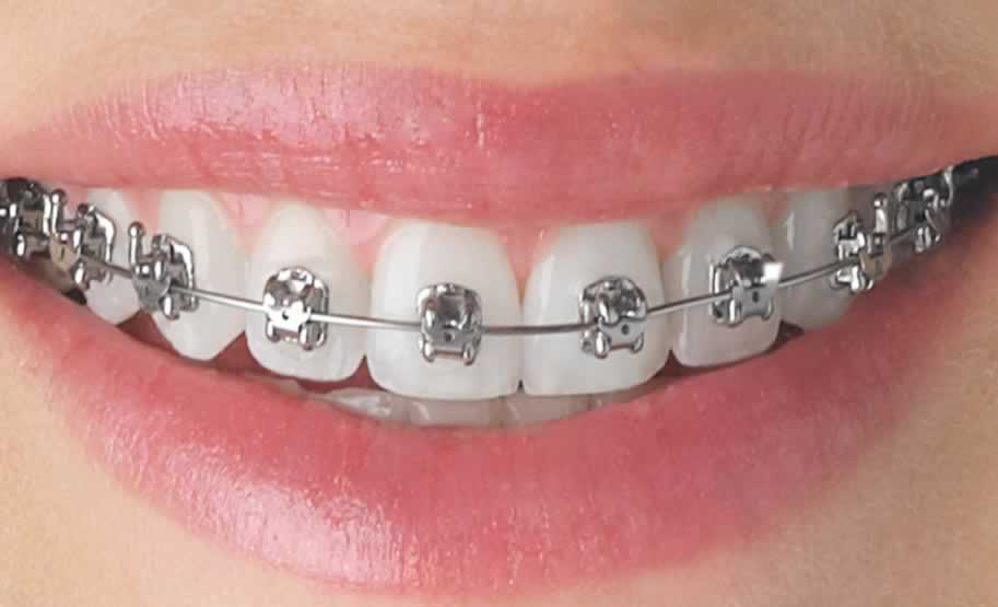 Brackets Plateados | Clínica Dental Artdenta Valencia