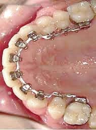 Brackets para paladar | Clínica Dental Artdenta Valencia