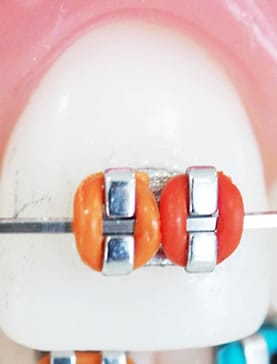 Diente con Ortodoncia de Colores| Clínica Dental Artdenta Valencia