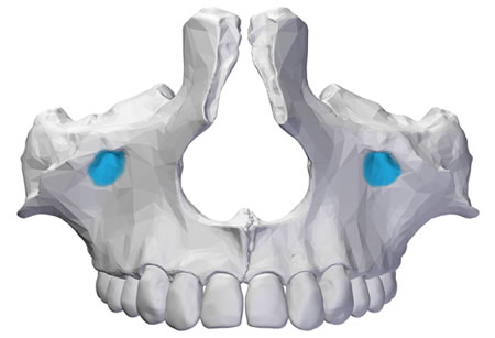 Hueso Maxilar Implante dental | Clínica Dental Artdenta Valencia