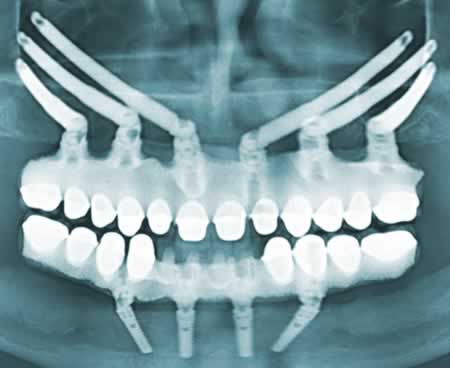 Implantes Carga Convencional | Clínica Dental Artdenta Valencia