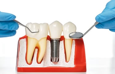 Implantes de Carga Inmediata | Clínica Dental Artdenta Valencia