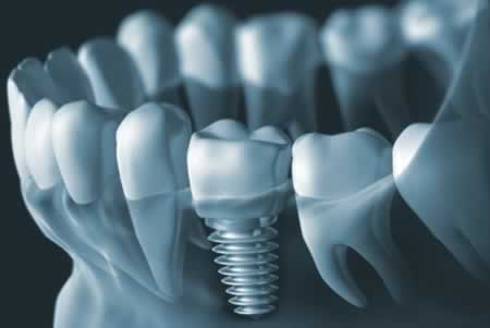 Osteointegración de Implantes Dentales | Clínica Dental Artdenta Valencia