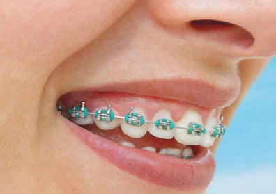 Sonrisa con Brackets de Colores| Clínica Dental Artdenta Valencia