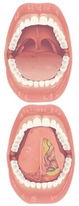 Estomatodinia - Lengua Geográfica | Clínica Dental Artdenta Valencia