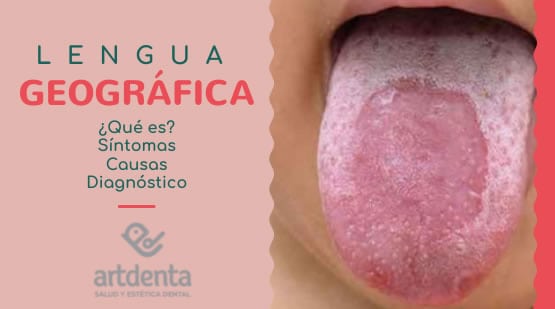 Banner Lengua Geográfica | Clínica Dental Artdenta Valencia