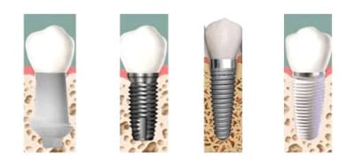 Clasificación de Implantes | Clínica Dental Artdenta Valencia