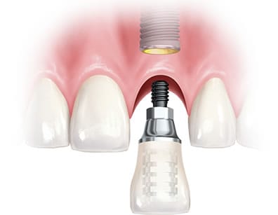 Implantes carga inmediata | Clínica Dental Artdenta Valencia
