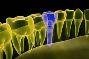 Osteointegración | Clínica Dental Artdenta Valencia