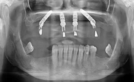Radiografia Implantes All in 4 | Clínica Dental Artdenta Valencia