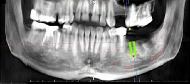 Tomografía Dental Computerizada | Clínica Dental Artdenta Valencia