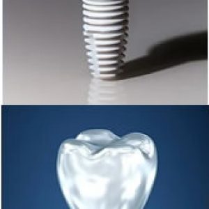 Implantes de Zirconio y titanio | Dental Artdenta Valencia