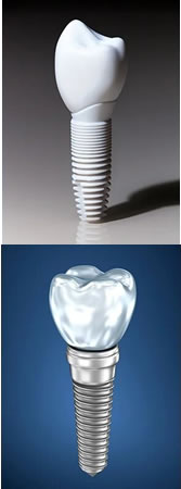 Implantes de Zirconio y titanio | Dental Artdenta Valencia