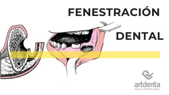 Fenestración Dental | Clínica Dental Dental Artdenta Valencia