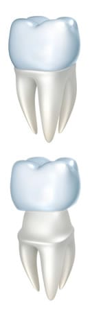 Colocacion de la Corona Dental | Clínica Dental Artdenta Valencia