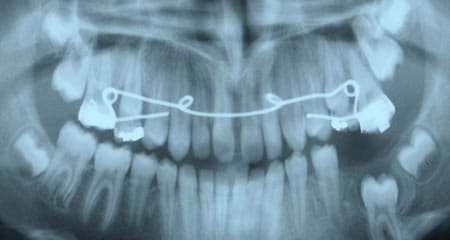 Radiografia problema Fenestración | Clínica Dental Artdenta Valencia