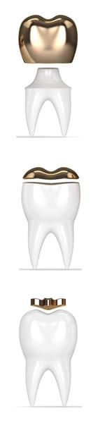 Zonas de una Corona Dental | Clínica Dental Artdenta Valencia