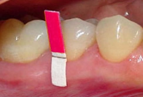 Encía Queratinizada | Dental Artdenta Valencia