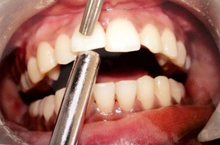Detección Movilidad Dental | Dental Artdenta Valencia