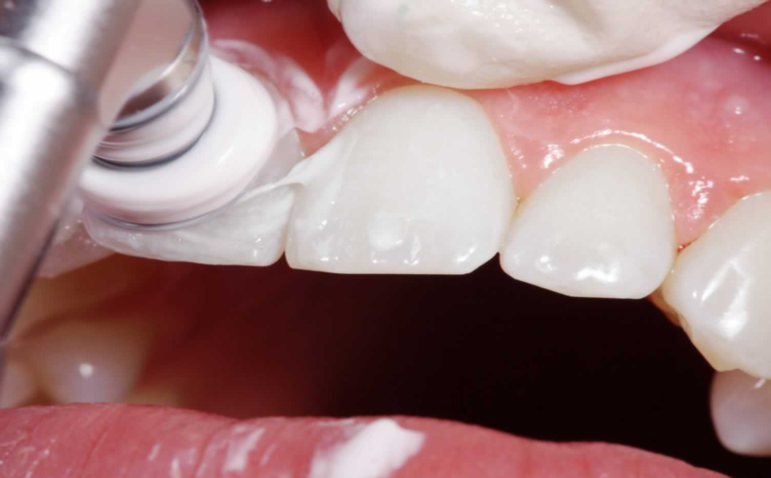 Limpieza Dental Periimplantitis | Dental Artdenta Valencia
