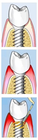 Implantoplastia Perimplantitis | Dental Artdenta Valencia