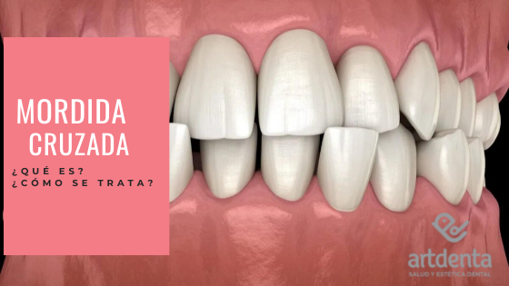 Mordida Cruzada - que es- tratamiento | Clínica Dental Artdenta Valencia