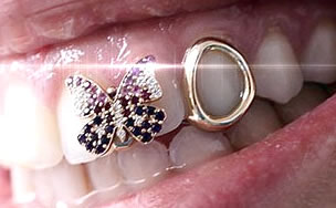 Grillzz en Dientes | Cl&iacute;nica Dental Artdenta Valencia