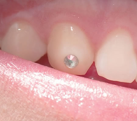 Pedrer&iacute;a Dental Gritzz | Cl&iacute;nica Dental Artdenta Valencia