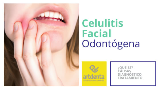 Celulitis Facial Odontogénica | Clínica Dental Artdenta Valencia