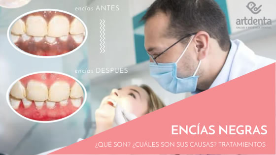 Banner Encías Negras | Clínica Dental Artdenta Valencia