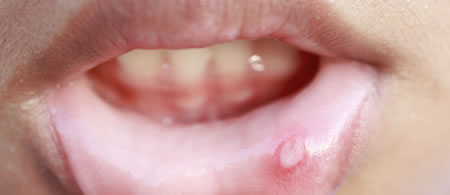 Clorhexidina y Aftas bucales | Cl&iacute;nica Dental Artdenta Valencia