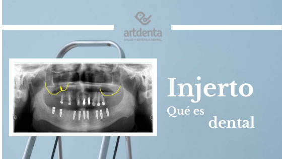 Banner Injerto Dental | Clínica Dental Artdenta Valencia