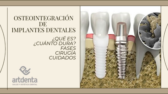 Banner Osteointegración | Clínica Dental Artdenta Valencia
