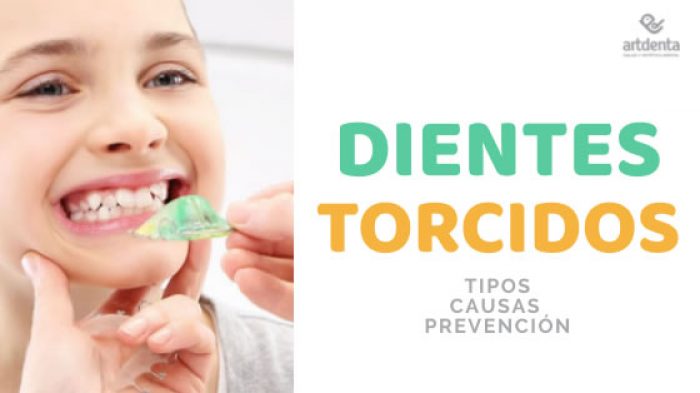 Dientes Torcidos. Tipos. Causas. Prevención. | Clínica Dental En ...