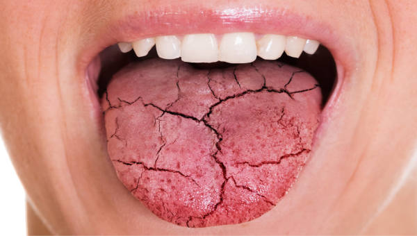 Agrietada Lengua Blanca | Clínica Dental Artdenta Valencia