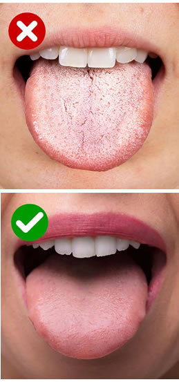 Lengua blanca | Dental Artdenta Valencia
