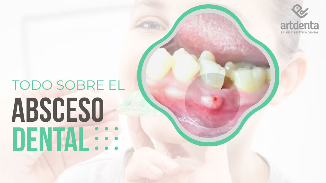 Todo sobre Absceso dental| Clínica Dental Artdenta Valencia