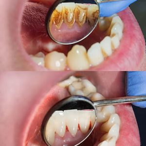 Dientes en fumadores | Clínica Dental Artdenta Valencia