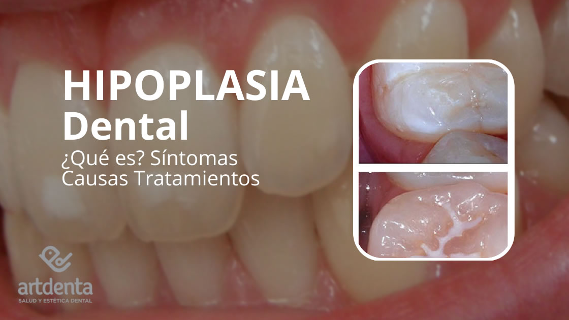 Banner Hipoplasia Dental | Clínica Dental Artdenta Valencia