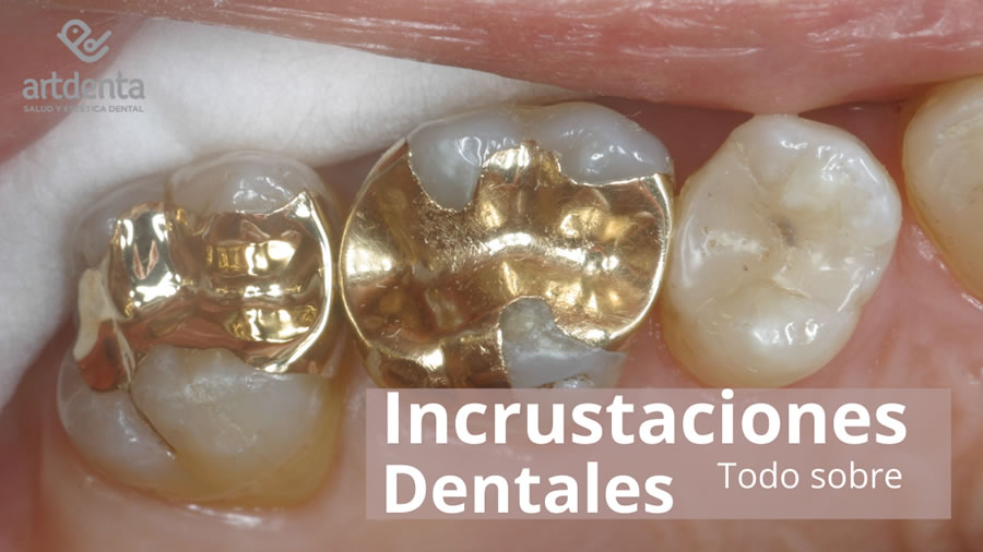 Banner Incrustaciones Dentales | Clínica Dental Artdenta Valencia