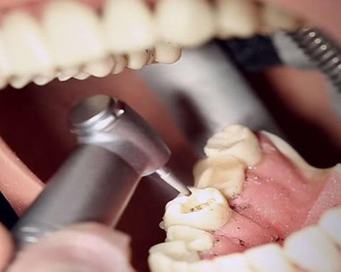 Utilización Turbina Dental | Clínica Dental Artdenta Valencia