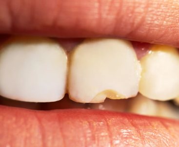 Neuralgia Dental - Rotura dental | Clínica Dental Artdenta Valencia