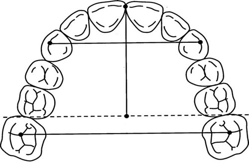 Arco Dental Superior | Clínica Dental Artdenta Valencia