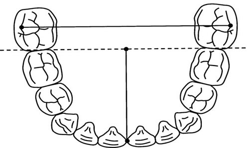 Arco Dental Inferior | Clínica Dental Artdenta Valencia