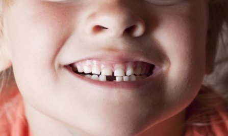 Agenesia Dental Infantil | Clínica Dental Artdenta Valencia